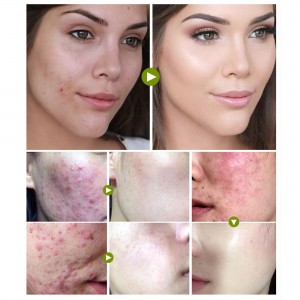 ACCUTANE 20MG/50TABS - STOP ACNE 