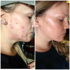 ACCUTANE 20MG/50TABS - STOP ACNE 